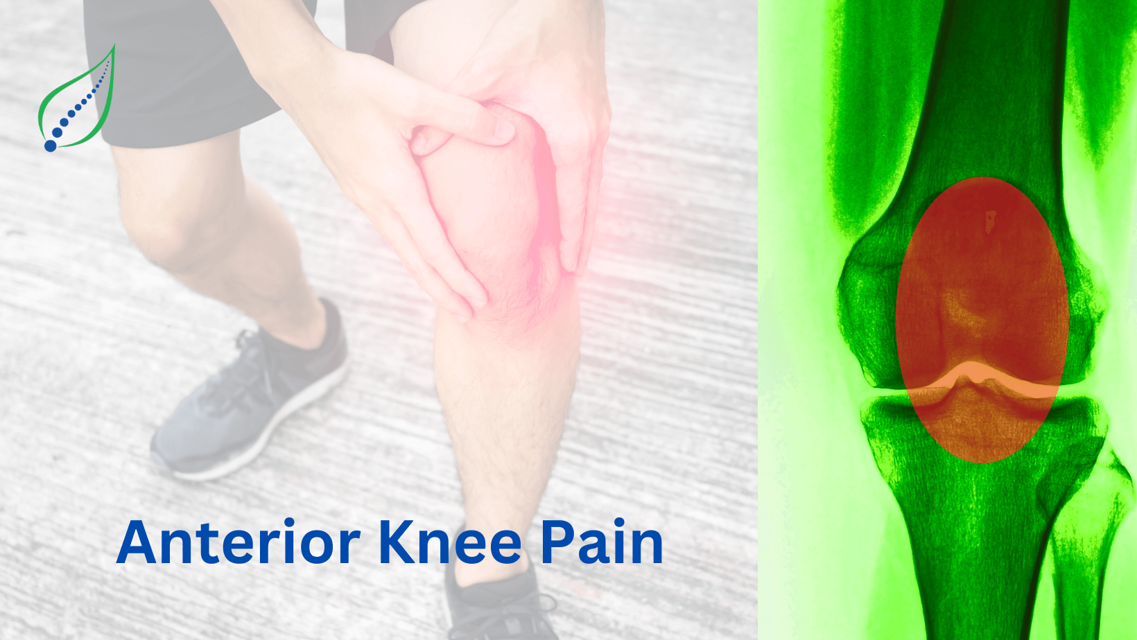 Anterior Knee Pain